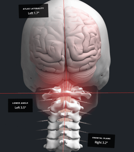 Diagram of a craniocervical junction misalignment and its correction